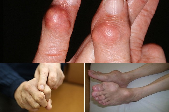 Bệnh gout ở nữ giới: triệu chứng, nguyên nhân và biến chứng-2