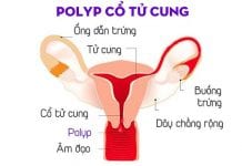 Bệnh Polyp cổ tử cung: Dấu hiệu, nguyên nhân và cách điều trị-1