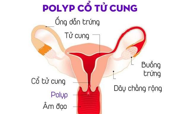 Bệnh Polyp cổ tử cung: Dấu hiệu, nguyên nhân và cách điều trị-1